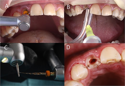 (A) Canal preparation, (B) canal irrigation, (C) file modification, (D) canal enlargement.