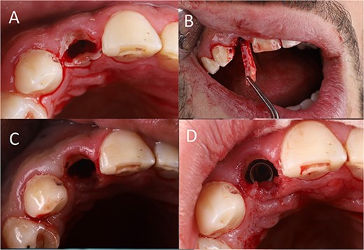 (A) Tooth separation, (B) partial tooth extraction, (C) shield preparation, (D) implant placement.