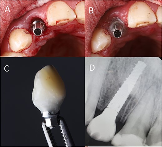 (A) Abutment placement, (B) adding flowable composite around the abutment, (C) crown build-up (D) postoperative radiograph.