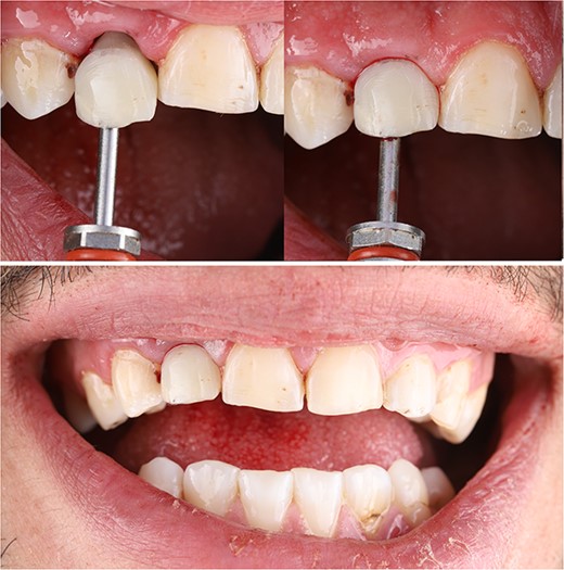 Immediately postoperative clinical photograph.