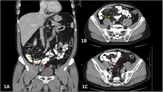 (A–C) Abdominal CT scan showing coronal and axial planes (A and B), indicating the inflamed appendix, highlighted by yellow arrows, and coronal and axial planes (A and C) showing the diverticulum arising from a loop of small bowel extending to the right iliac fossa and right pelvis, highlighted within a red circle.
