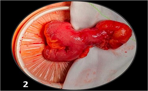 Intraoperative findings include a loop of ileum with a 3 cm blind pouch on the antimesenteric aspect (an MD).