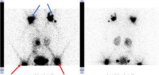 Lymphoscintigraphy: blue arrow indicates axillary lymph nodes, the red arrow shows the inguinal lymph nodes. They are no signs of tracers in the thorax cavity.