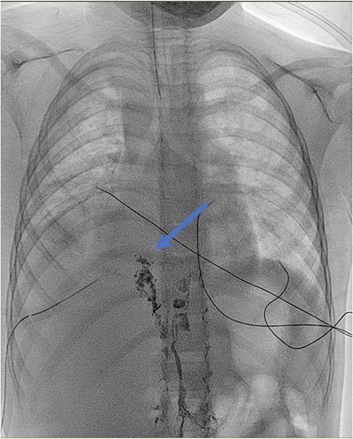 Lymphangiography: detection of lipiodol in the ductus thoracicus (blue arrow). The marker stops at the clipping of the ductus thoracicus. No leakage is detected.