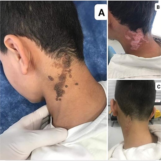 (A) A dome-shaped, dark-pigmented nodule on the left side of neck nape NS. (B) NS 3 months after treatment. (C) NS 1 year after treatment.