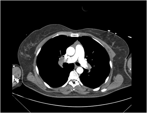 CT Pulmonary Angiogram demonstrating filling defects in the left and right pulmonary arteries.