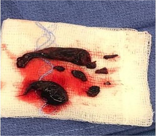 Extracted emboli from the index case.