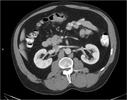 Axial CT scan with IV contrast showing thickened transverse colon.