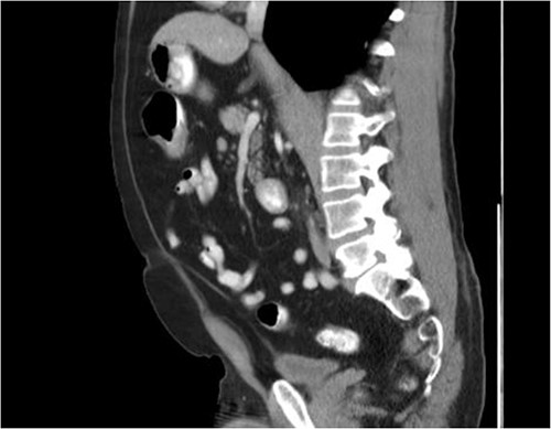 Sagittal view with thickened transverse colon.