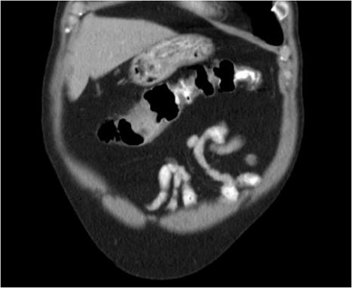 Coronal view with transverse colon mass.