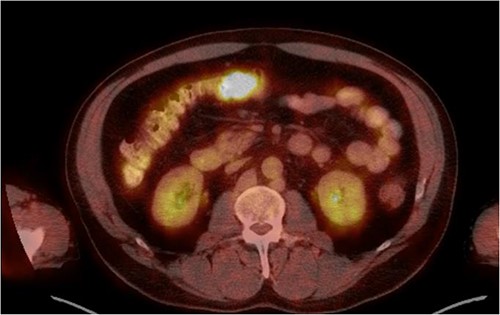 Axial FDG-PET of transverse colon mass.