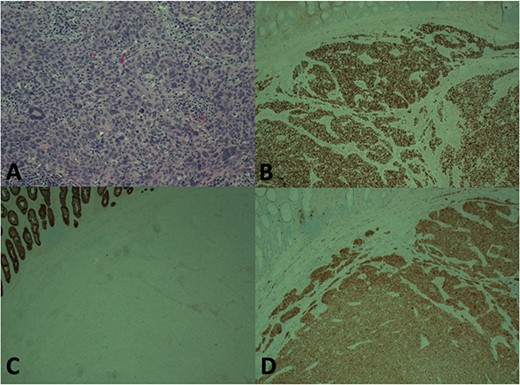Histology showing H and E stain (A), Immunohistochemistry (IHC) for SOX-10 (B), IHC for CKC (C), IHC for S100 (D). Staining pattern consistent with melanoma