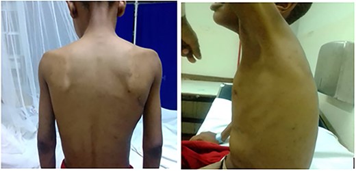 Barrel shape of the chest with scoliosis.