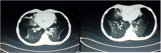 Axial view of CT scan of the chest showed multiple cystic lesions of varying sizes, with thin walls are seen in both lungs.