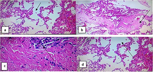 A huge bullae of the right hemi-thorax was seen; it was arising from right middle lobe.