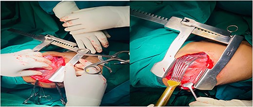 Section of tissue from the lung shows destructed alveoli, bronchiectasis organizing fibrosis (black arrow on a and b); large undulating cystic dilated alveoli with a fibrous wall and dilated vessels (black arrow on d); mild per-bronchial and parenchymal inflammatory cell infiltrate, lymphocytes and neutrophils (black arrow on c).