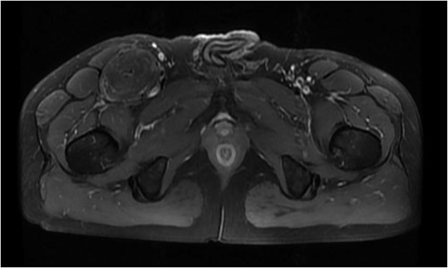 Equal and slightly high signal in T1W1 + C.