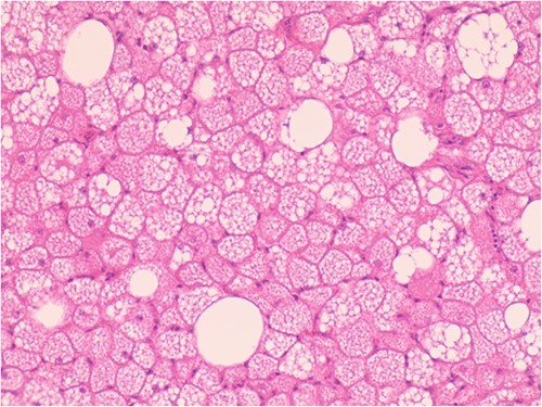 Hypertrophic adipoid cells with abundant interstitial vessels (HE*400).