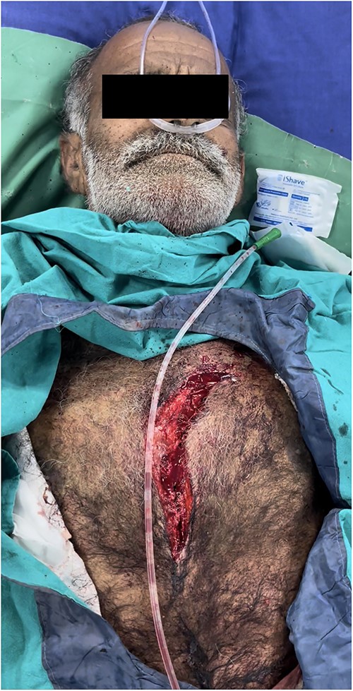 Penetrating chest injury at presentation.