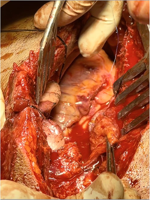 Intraoperative findings (sternal retraction with mastoid retractor)—hemopericardium with full thickness RVOT tear and partial thickness RV laceration.