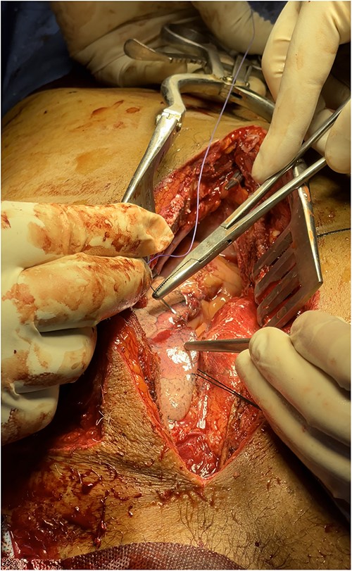 Repair of lung laceration.