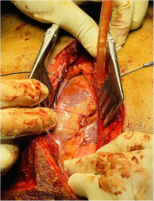 Repair of RVOT tear and partial thickness RV laceration.
