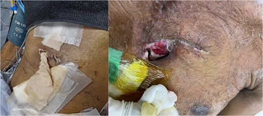 Wound infection with subsequent development of sternal instability and mediastinitis.