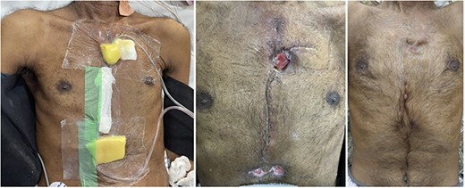 VAC dressing on Day 17; wound at discharge on Day 30; and at Day 60.