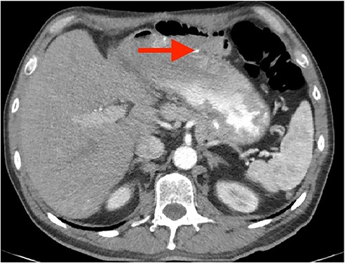 Axial CT image depicting gastrojejunal anastomosis (arrow).