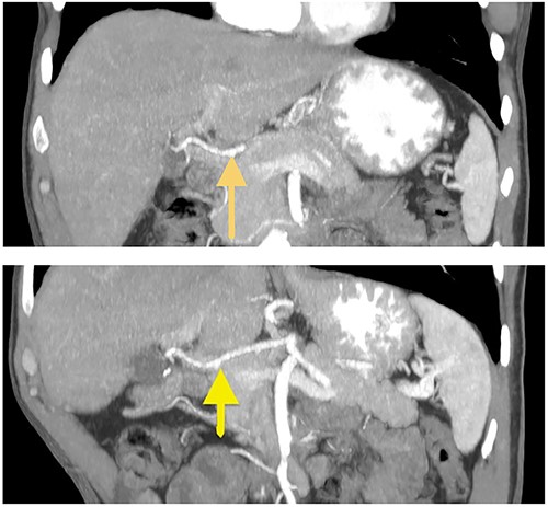 Coronal CT images of stomach’s vascular supply (arrows showing RGEA absence).