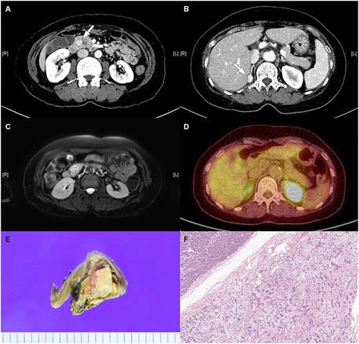 Radiologic images of the (A) pancreatic mass in the uncinate process of the pancreas on CT, (B) right adrenal mass on CT, (C) pancreatic mass on MRI, and (D) pancreatic mass on PET. (E) Gross pathology: well-demarcated whitish to tan-colored mass with mild hemorrhage and (F) microscopic findings: variably cystic small to medium-sized ductular structures surrounded by collagenized stroma.