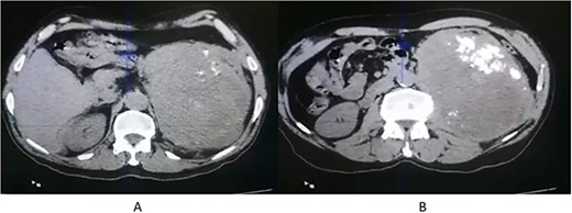 CT scan axial (A, B) showing left renal solid mass, disrupting the upper two-third of renal parenchyma, with thick dystrophic calcifications (B).