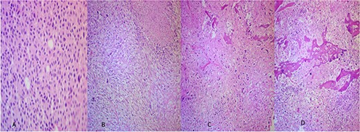 (A) The CRCC area (×40). (B) Sarcomatoid areas showing atypical lacy mineralized bone material and large pleomorphic spindle cell proliferation with necrosis (×40). (C, D) Osteosarcomatous areas showing atypical lacy mineralized bone material, and atypical spindle cells existing between the osteoid (×40).