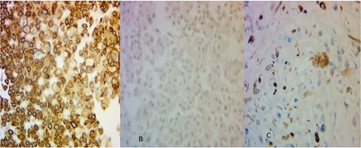 (A) The areas of CRCC were positive for CK7 (×40) and (B) negative for CA-IX (×40). The osteosarcoma-like areas were focally and strongly positive for CK AE1/AE3 (×40).