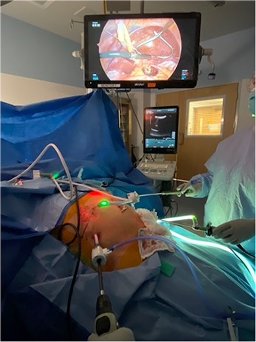 Patient positioned in reverse Trendelenburg to facilitate exposure of upper abdomen. Port placement: 12 mm port in right upper quadrant to facilitate laparoscopic ultrasound of liver, other 5 mm ports placed as needed for mobilization of liver. Laparoscopic image above patient demonstrates left lobe of liver elevated with retractor, laparoscopic ultrasound probe evaluating left lobe of the liver, and burned area visible in caudate lobe below.