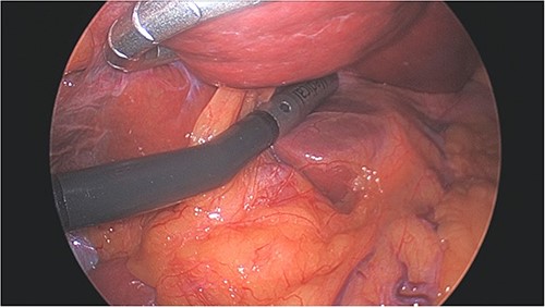 Left lobe of liver elevated with flexible liver retractor, facilitating laparoscopic ultrasound evaluation of caudate lobe.