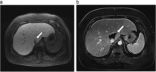 (a) Pre-ablation MRI demonstrates 6 mm lesion in caudate lobe of liver. (b) Post-ablation MRI (18 days postoperatively) demonstrates 40.4 mm complete ablation site in caudate lobe of liver.