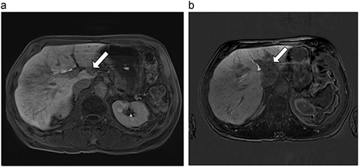 (a) Pre-ablation MRI demonstrating 15 mm lesion in caudate lobe of liver (image degraded by motion artifact). (b) Post-ablation MRI (20 days postoperatively) demonstrating 35 mm complete ablation of caudate lesion (image degraded by motion artifact).