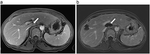 (a) Pre-ablation MRI demonstrating 5 mm lesion in caudate lobe of liver. (b) Post-ablation MRI (19 days postoperatively) demonstrating 36.2 mm complete ablation of caudate lesion.
