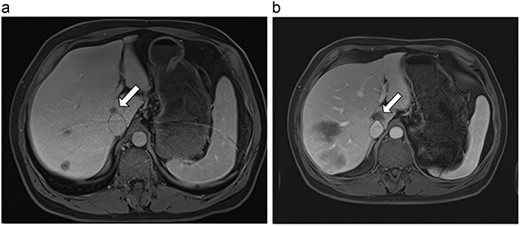 (a) Pre-ablation MRI demonstrating 14 mm lesion in caudate lobe of liver. (b) Post-ablation MRI (23 days postoperatively) demonstrating 23.8 mm complete ablation of caudate lesion.
