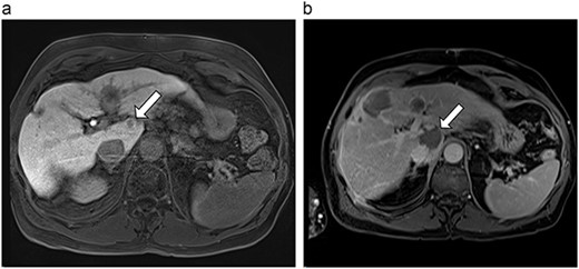 (a) Pre-ablation MRI demonstrating 10 mm caudate lesion. (b) Post-ablation MRI (14 days postoperatively) demonstrating 35.9 mm complete ablation of caudate lesion.