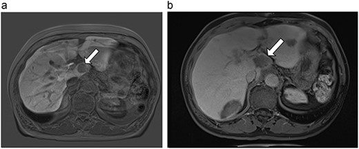 (a) Pre-ablation MRI demonstrating 28 mm caudate lesion. (b) Post-ablation MRI (16 days postoperatively) demonstrating 37.3 mm complete ablation of caudate lesion.