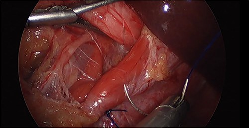 Laparoscopic image of the hiatal hernioplasty during the initial surgery.