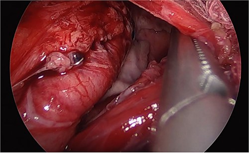 Laparoscopic image of the second surgery showing the presence of purulent fluid, fibrinopurulent tissue, and migration of the gastric sleeve into the thorax.