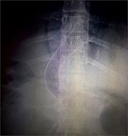 Thorax X-ray showing the placement of the gastroesophageal stent above the gastroesophageal junction.