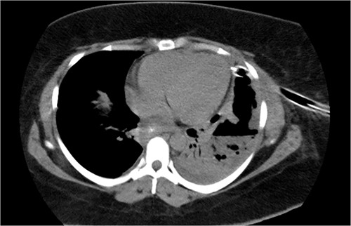 Chest tomography revealing the presence of left pleural fluid and cavitations.