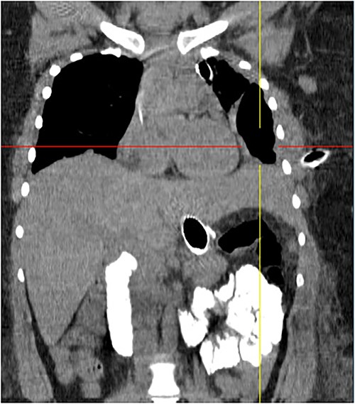 Coronal chest tomography showing the presence of the gastroesophageal stent and the left pleurothoracic cavity.