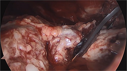 Thoracoscopy (VATS) revealing the presence of fibrinopurulent tissue in the left thoracic cavity.