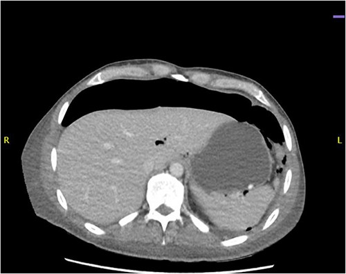 CT abdomen showing a large amount of free air mostly localized anterior.