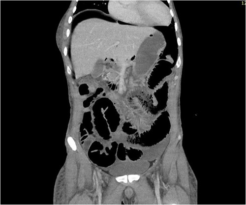 CT abdomen showing large amount of free air throughout the abdomen.